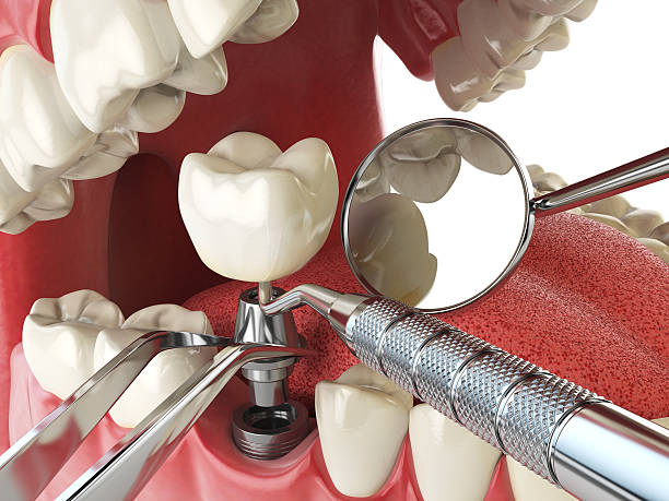 Dentist for Dental Trauma in CA